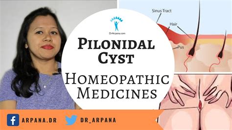 पीलोनिडल सिस्ट के कारन लक्षण व इलाज What Is Pilonidal Cyst And Best Homeopathic Treatment