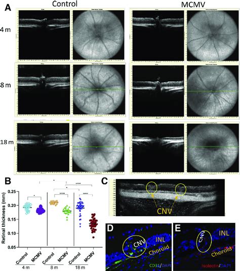 Spectral Domain Optical Coherence Tomography Sd Oct And Choroidal