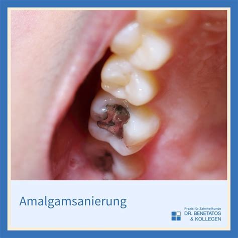 Amalgam sicher entfernen lassen in München Unterföhring Blog Post