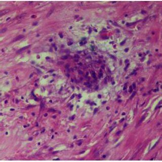 Microphotograph Showing Foci Of Epithelioid Cell Granulomas H E 40x