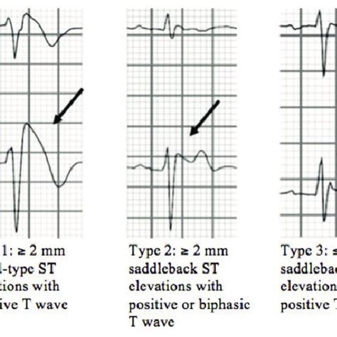 Type 1 is diagnostic for Brugada syndrome. Type 2 or Type 3 is... | Download Scientific Diagram