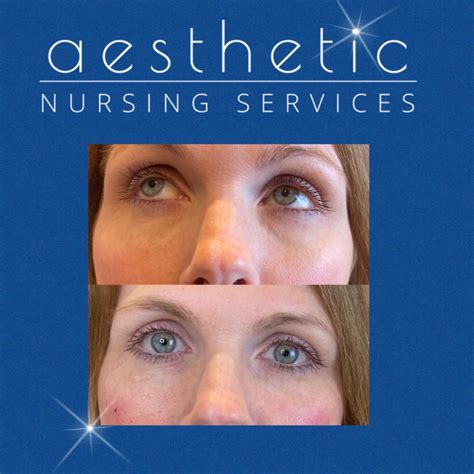 Tear Trough 1 Aesthetic Nursing Services