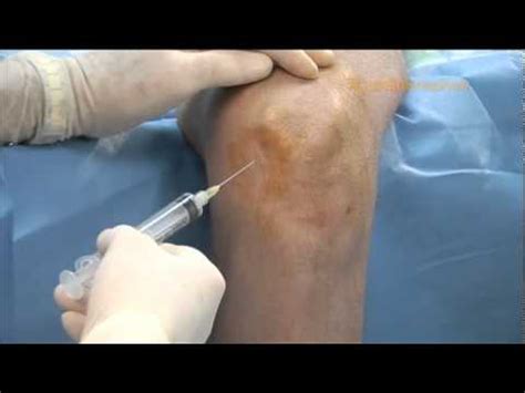 Inferior Medial Injection Technique Youtube