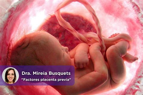 Factores De Riesgo De Placenta Previa MediQuo