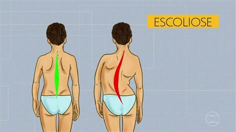 Escoliose saiba o que é causas e como dever tratamento Bom Dia PE G1