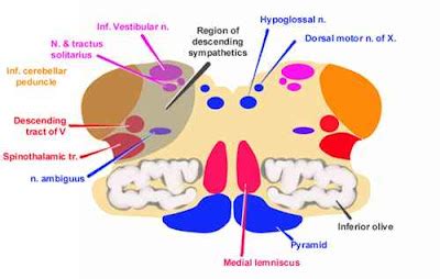 Wallenberg S Lateral Medullary Syndrome Medik Ukm