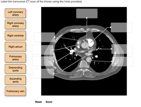 Solved Label The Transverse Ct Scan Of The Thorax Using The Hints