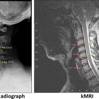 Subaxial C To C Segmental Angle Measurement On Plain Radiograph