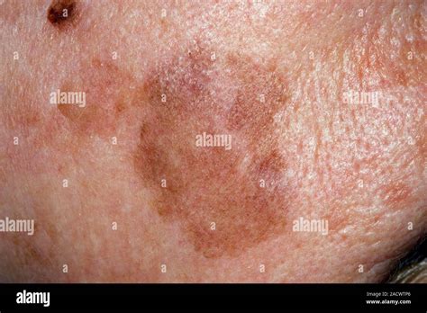 Lentigo Maligna On The Skin Of A Year Old Female Patient This Is A