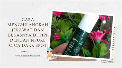 Cara Menghilangkan Jerawat Dan Bekasnya Di Pipi With NPURE