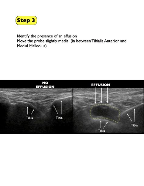 Ankle Arthrocentesis — Highland EM Ultrasound Fueled pain management