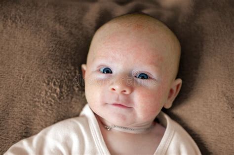 Allergien Atopic Dermatitis Auf Dem Gesicht Stockfoto Bild Von