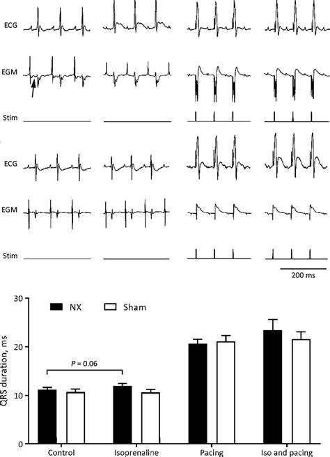 A Representative Surface Electrocardiograms Ecg And Intracardiac