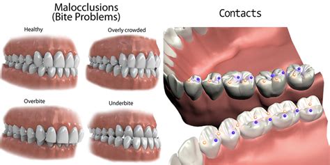 Occlusion Dr Gais Dental Center Aesthetic Dentistry And Dental