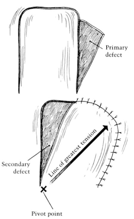 Local Flap Surgery In Ottawa ON Skin Cancer Reconstruction