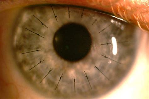 Corneal Donation And Corneal Transplantation In Aotearoa Nzoptics