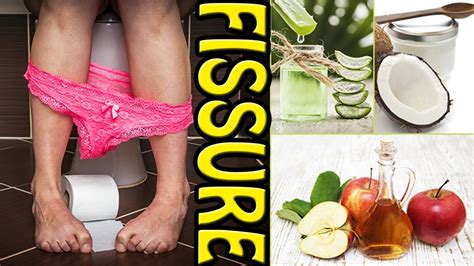 How To Cure Fissure Permanently At Home 5 Best Treatment Options For