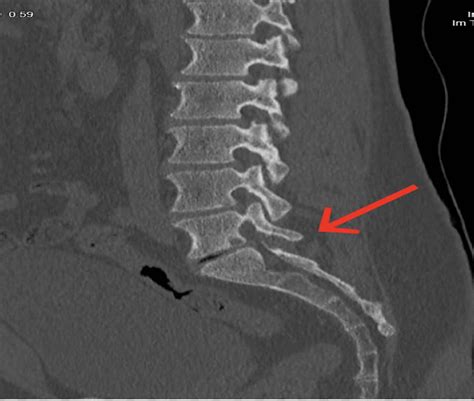 Black Urine Disease: A Complex Condition