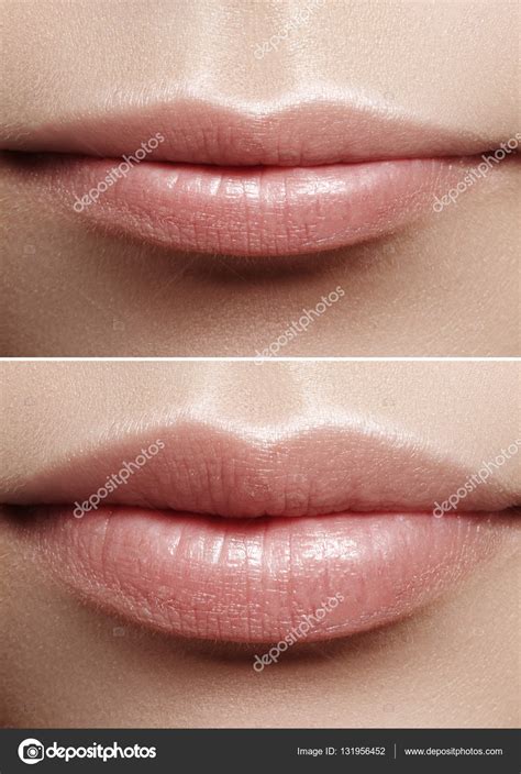 How To Inject Filler In Lips Naturally