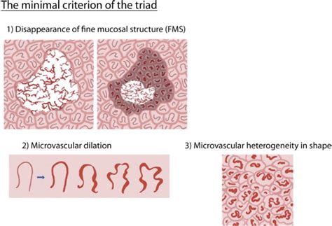 Magnifying Endoscopy With Narrow Band Imaging Achieves Superior Accuracy In The Differential