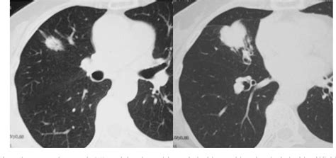 Figure 1 From Diagnosis Of Synchronous Primary Lung Adenocarcinomas Based On Epidermal Growth