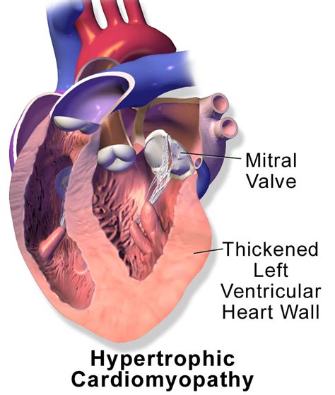 Hypertrophic Cardiomyopathy Types