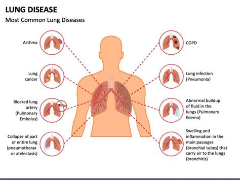 Lung Disease PowerPoint and Google Slides Template | Lung disease, Google slides, Google slides ...