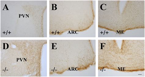 Gonadotropin Positive Pituitary Tumors Accompanied By Ovarian Tumors In