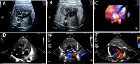 Frontiers Prenatal Diagnosis And Postnatal Verification In Fetuses