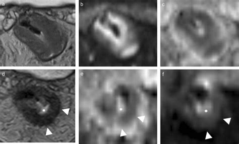 A 52 Year Old Man With Mid Third Rectal Cancer A Axial T2 Weighted