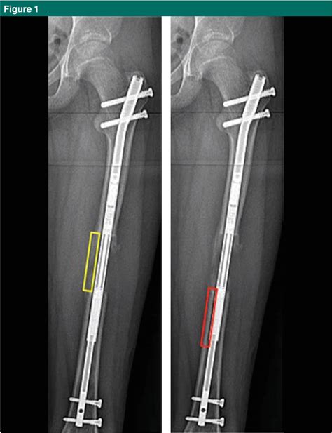 Figure 1 from Assessment of Bone Healing During Antegrade ...