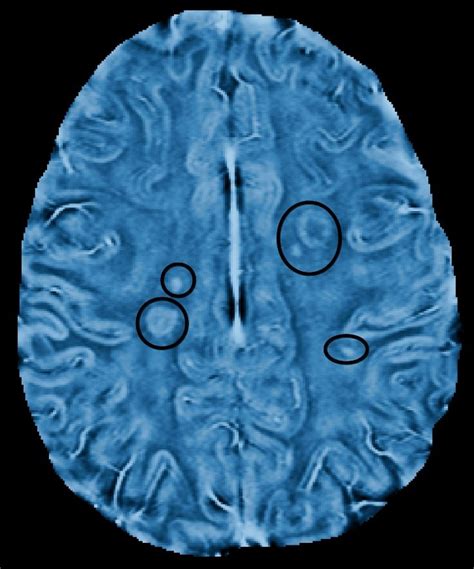 Mri Brain Scan Ms