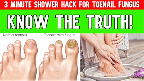 Minute Shower Hack For Toenail Fungus Kerassentials Oil Nail