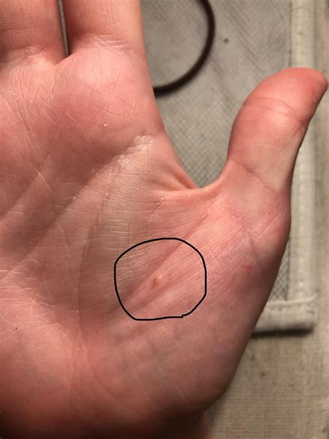 Malignant Melanoma Freckle On Palm Of Hand Normal What Are Freckles Plus When To See Your