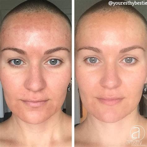 How Long Until I See Results From Microneedling Best Simple