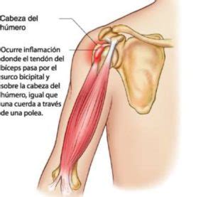 Tendinopatía de hombro derecho causas y tratamiento efectivo