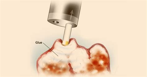 Variceal Glue Injection Best Gastroenterologist In Ahmedabad India