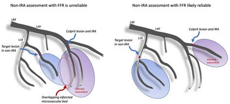 Anatomic Dependence Of Non Ira Assessment In Acute Coronary Syndromes