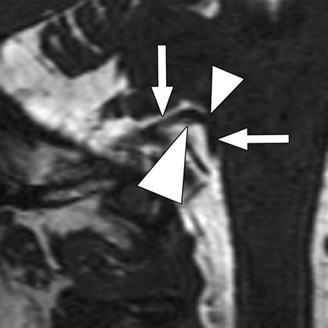 Mri Of Glossopharyngeal Neuralgia Caused By Neurovascular Compression Ajr