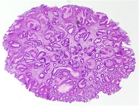 Pathology Outlines Hyperplastic Polyp