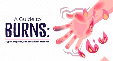 Guide To Types Degrees And Treatment For Burns Makati Med