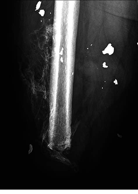 Radiograph Showing Moderate Amount Of Heterotopic Ossification Ho Download Scientific