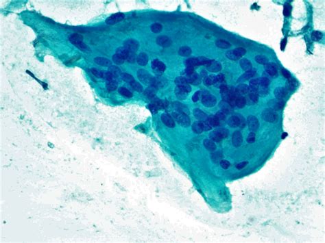 Pathology Outlines Subacute Thyroiditis