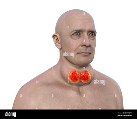 3d Illustration Of A Man With An Enlarged Thyroid Gland Goitre Base