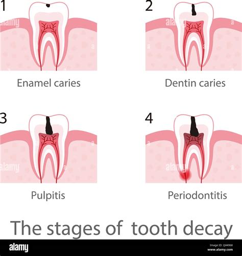 The Stages Of Tooth Decay Vector Illustration Stock Vector Image And Art