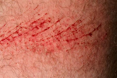 Scratch Skin Wound Or Cut On The Skin Red Blood Hairy Part Of A Man