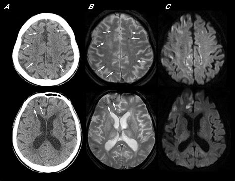 Cerebral Air Emboli On T2 Weighted Gradient Echo Magnetic Resonance