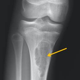 Nonossifying Fibroma