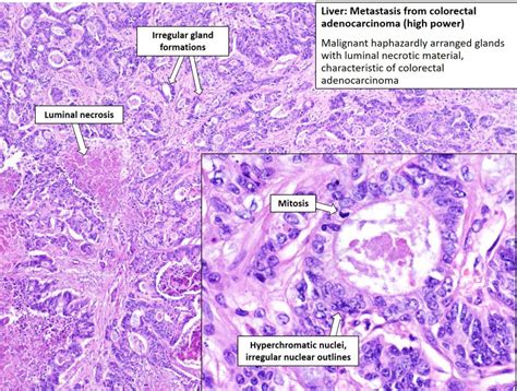 Liver Metastatic Carcinoma NUS Pathweb NUS Pathweb