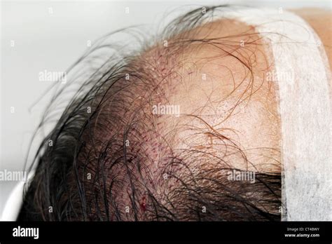 IMPLANT HAIR SURGERY Stock Photo - Alamy